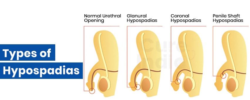 types of hypospadias